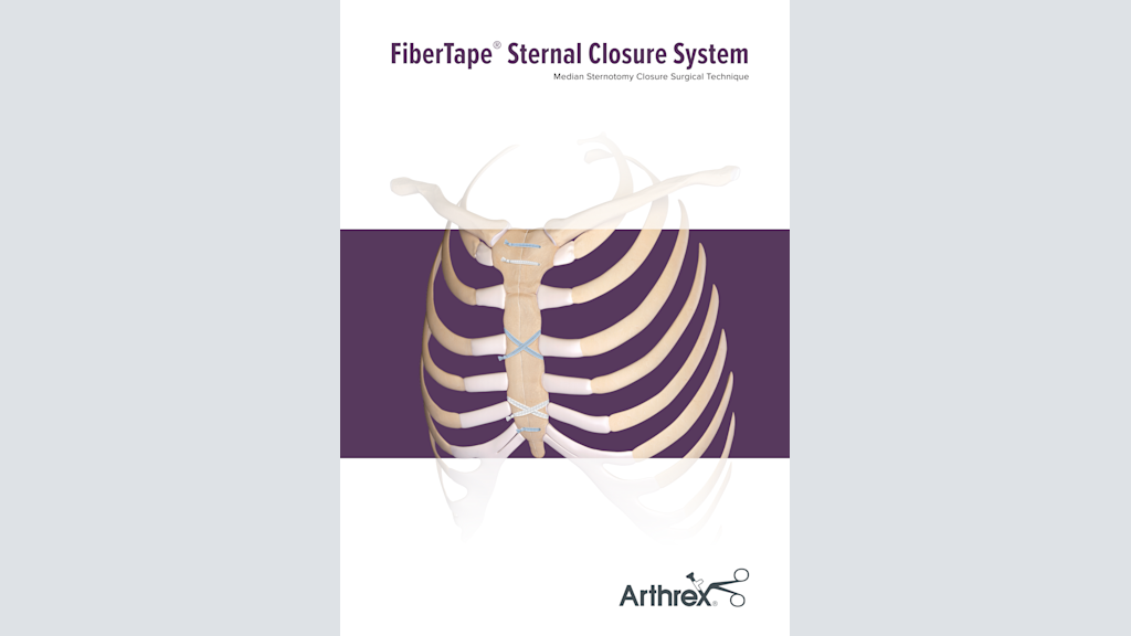 FiberTape® Sternal Closure System