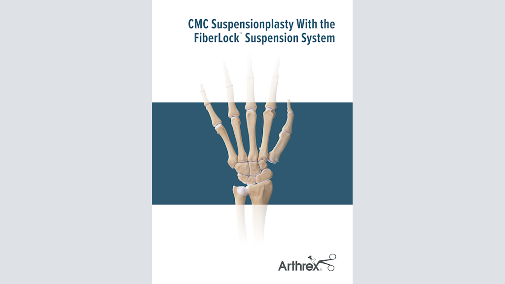 CMC Suspensionplasty With the FiberLock™ Suspension System