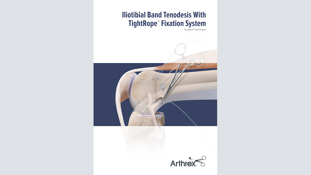 Iliotibial Band Tenodesis With TightRope® Fixation System