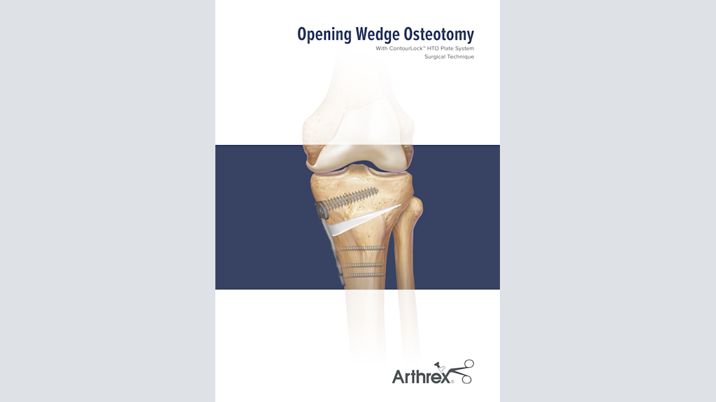 Opening Wedge Osteotomy With ContourLock™ HTO Plate System Surgical Technique
