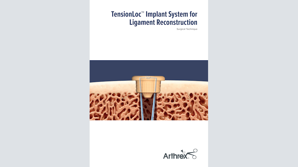 TensionLoc™ Implant System for Ligament Reconstruction
