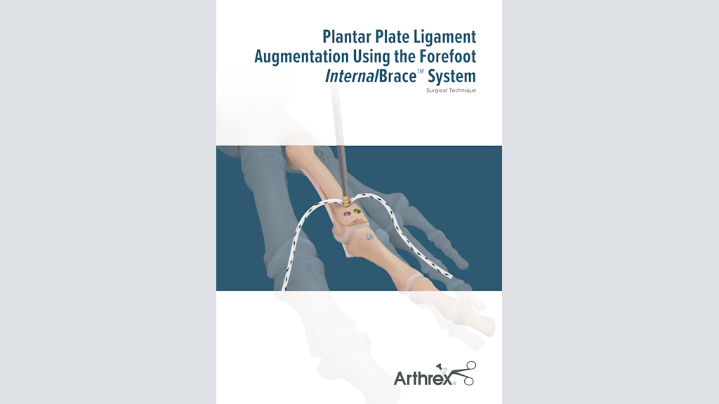 Plantar Plate Ligament Augmentation Using the Forefoot InternalBrace™ System