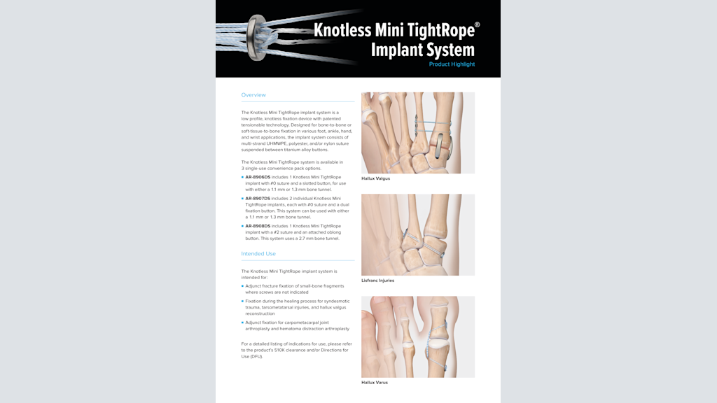 Knotless Mini TightRope® Implant System