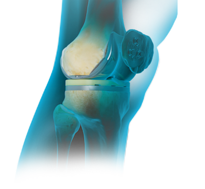 Artroplastia total de joelho – Primária