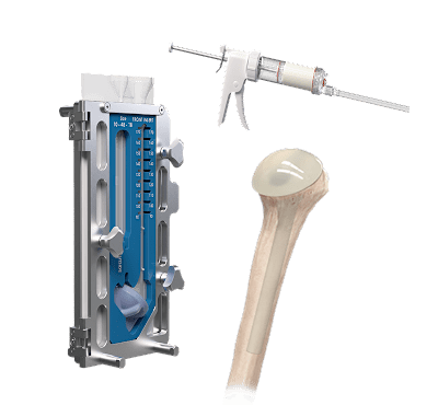 CeMend™ Shoulder Spacer Molds