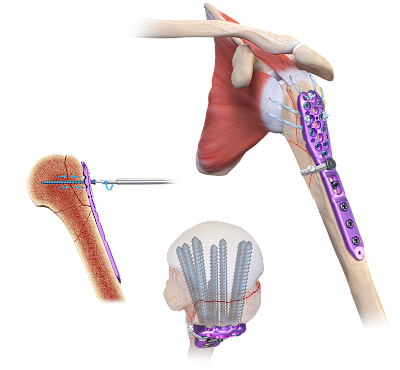 Arthrex Proximal Humeral Plating System