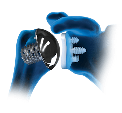 
Arthrex Eclipse™-Schultertotalendoprothesensystem