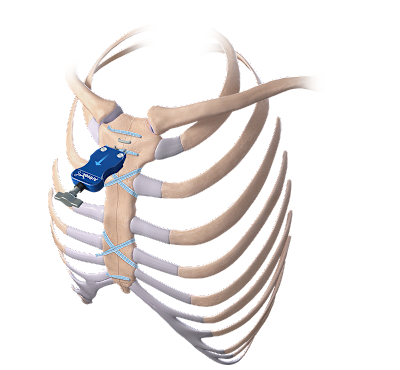 DynaNite® CT Nitinol Staples for Sternal Closure