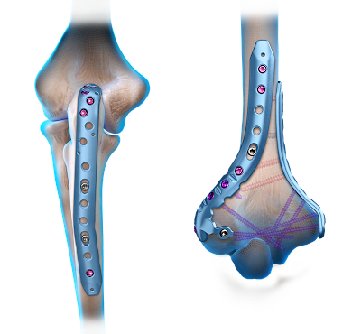 Elbow Fracture Plating System