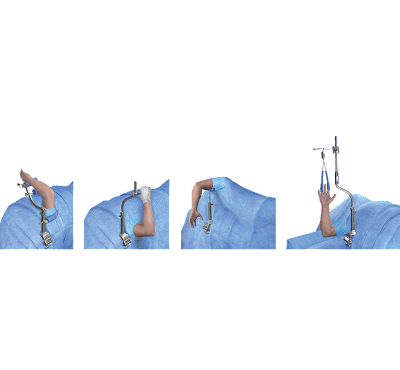 ElbowLOC® Arm Positioning System