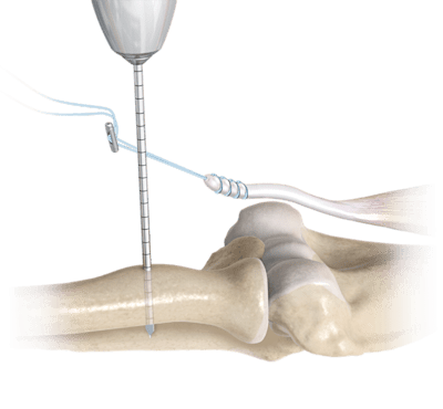 Cortical Button Fixation