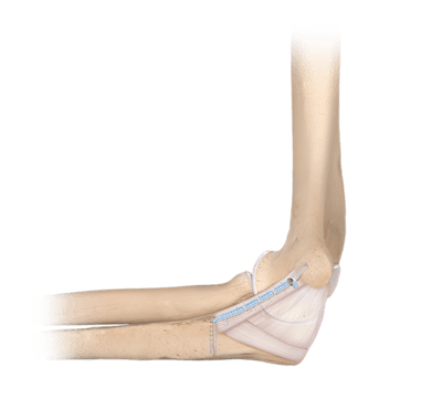 Sistema <em>Internal</em>Brace™ para LCU