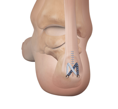 Sehnenfixierung bei Insertionstendinopathie der Achillessehne