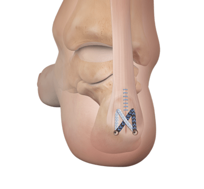 Fixação de tendão para tendinopatia insercional do Aquiles