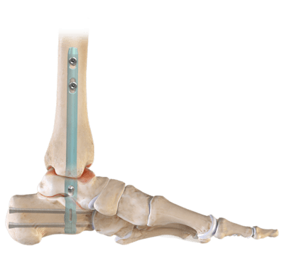 DualCompression Hindfoot Nail