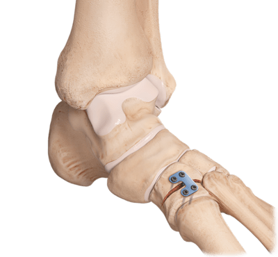 Cotton Osteotomy