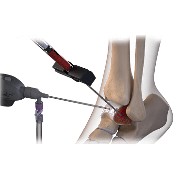 IntraOsseous BioPlasty® Technique for Foot and Ankle