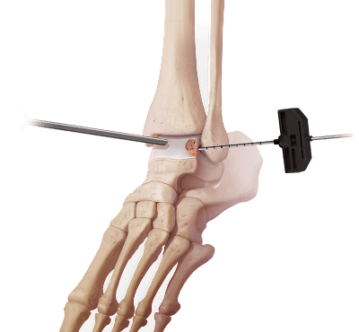 IntraOsseous BioPlasty® Technique for Foot and Ankle