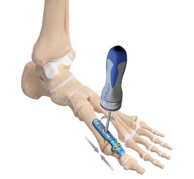 MTP Joint Arthrodesis