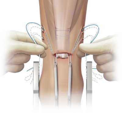 Técnica com sutura FiberWire<sup>®</sup> para ruptura do tendão de Aquiles