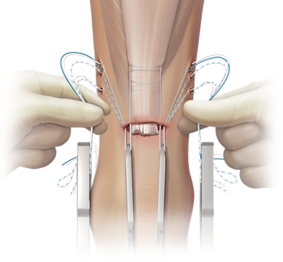 PARS SutureTape Technique for Achilles Rupture