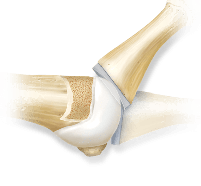 Prótese parcial anatômica