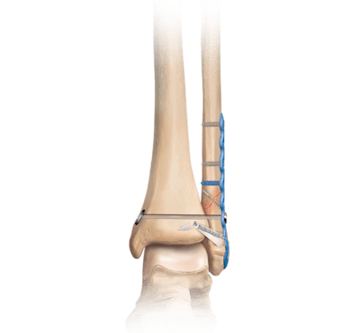 Fixação interna da fratura do tornozelo
