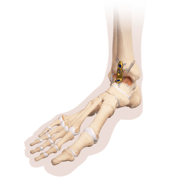 Ankle Fusion