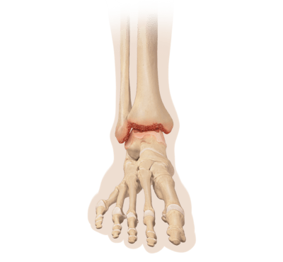 Artritis de tobillo