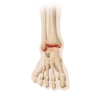 Ankle Arthritis