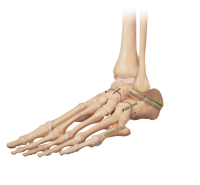 Artrodesis triple (Artritis)