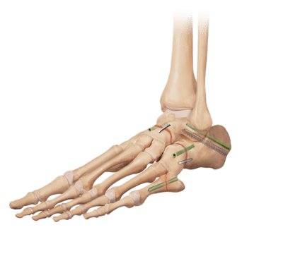 Die Triple-Arthrodese