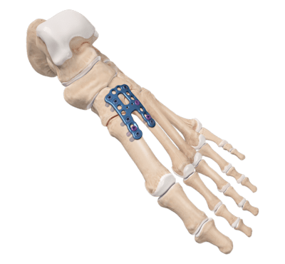 Artrodese da articulação de Lisfranc