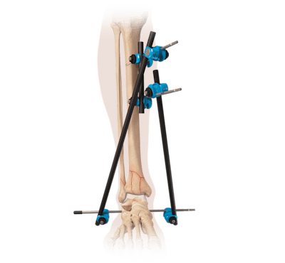 ArthroFX® Large External Fixation System