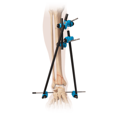 External Fixation