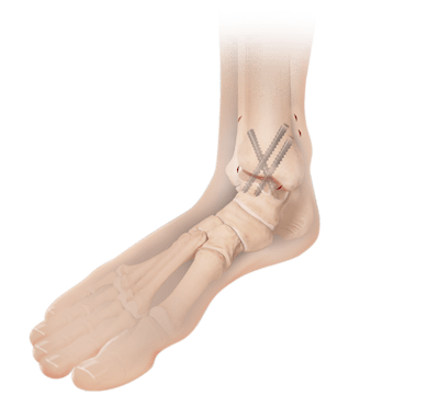 Fusão artroscópica do tornozelo