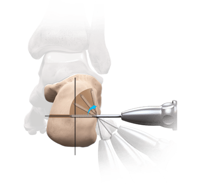 Calcaneal Osteotomy for Flatfoot