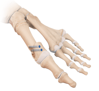 Chevron Osteotomy