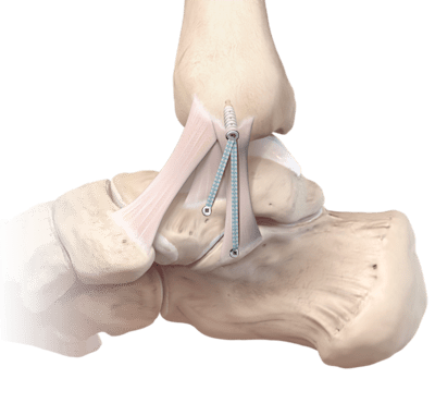 Inestabilidad del deltoides