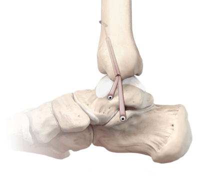 Reconstrucción del ligamento deltoideo