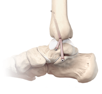 Deltoid Ligament Reconstruction