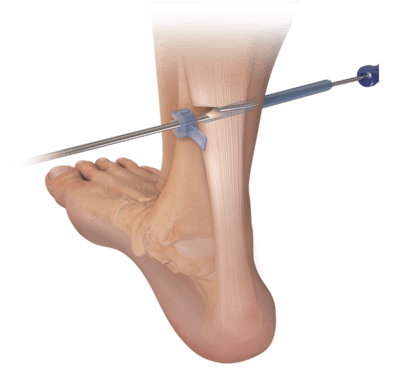 Endoskopische Tenotomie des M. gastrocnemius