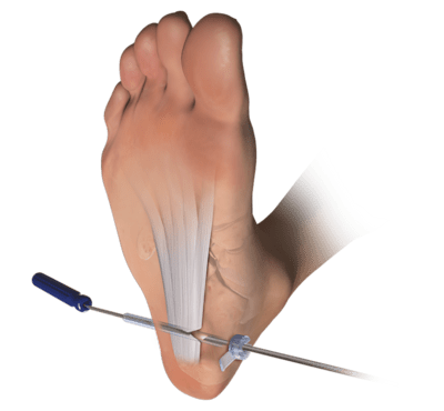 Endoscopic Plantar Fascia