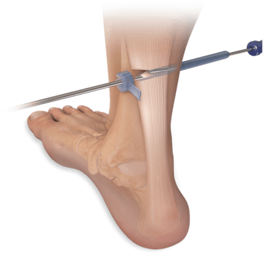 Equinus Contracture