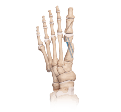 Osteotomía del primer metatarsiano
