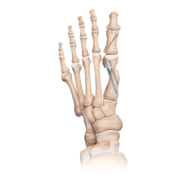 First Metatarsal Osteotomy