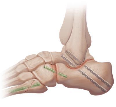 Subtalare Arthrodese (Plattfuß)