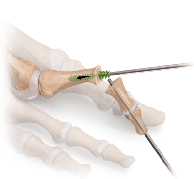 RetroFusion™-Implantat für die Arthrodese des PIP-Gelenks