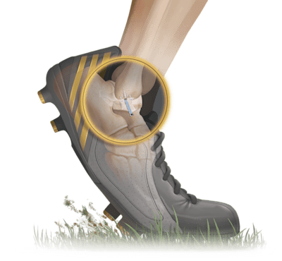 <em>Internal</em>Brace™ Technique for Brostrom Repair