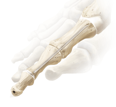 Fusión de la articulación interfalángica